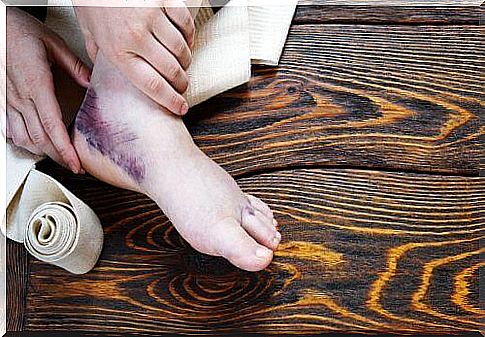 Additional Remedies for a Sprained Ankle