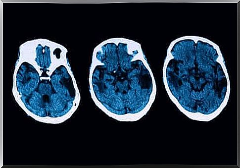 Diagnosis of Posterior Cortical Atrophy