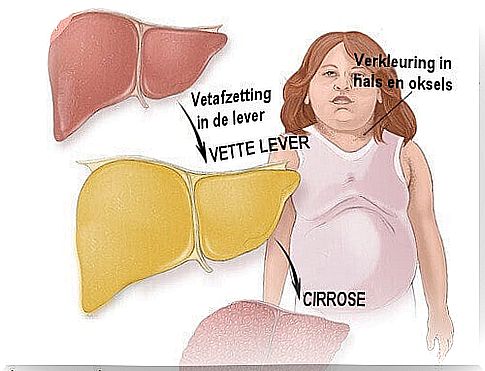 Do you have fatty liver?  Recognize the symptoms