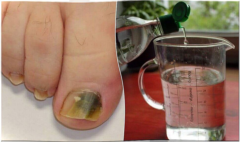 Fight fungal nails with this natural recipe