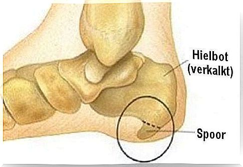 Heel Spurs: Symptoms and Treatment