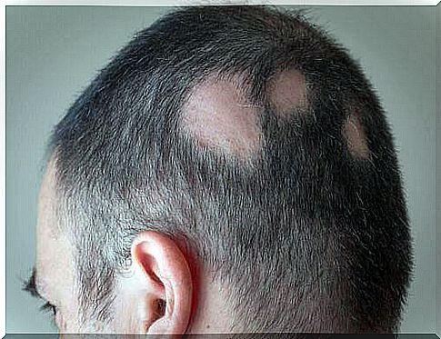 How to fight alopecia with natural remedies