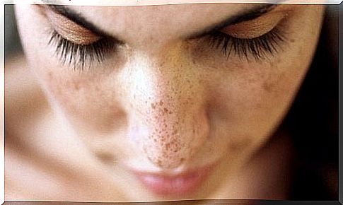 Reduce freckles with 6 natural remedies