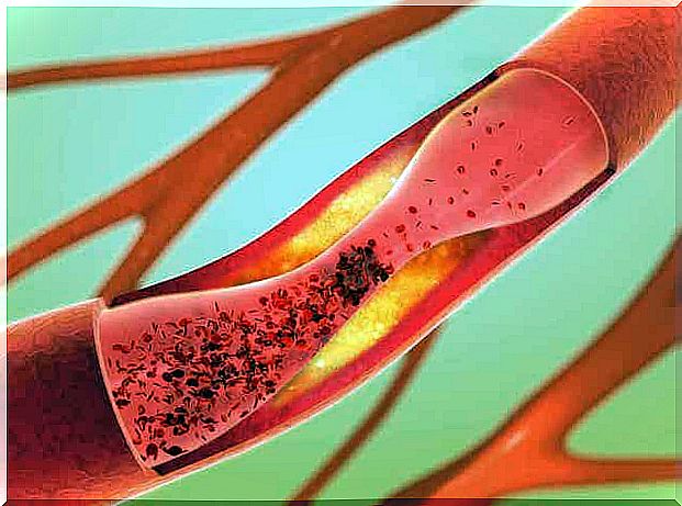 Causes of Elevated Lipid Levels in the Blood