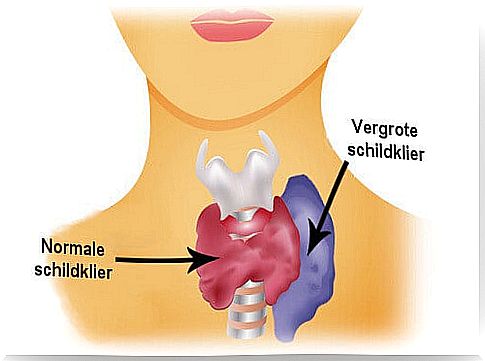 Enlarged Thyroid Gland