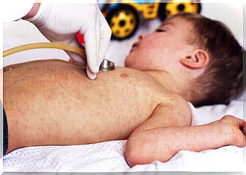 Staphylococcal scalded skin syndrome