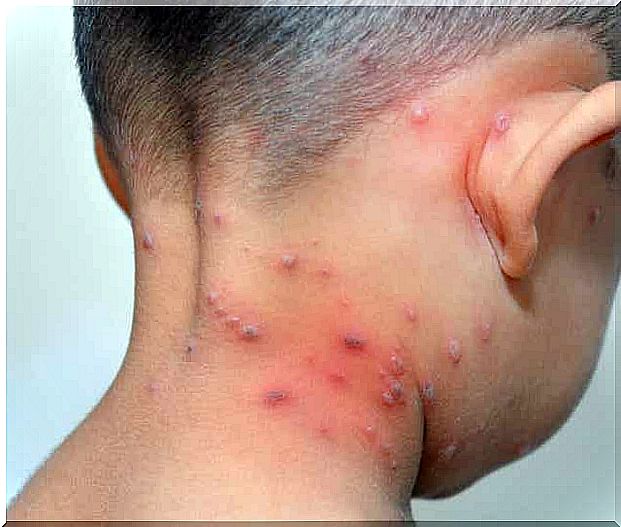 Staphylococcal scalded skin syndrome and its symptoms