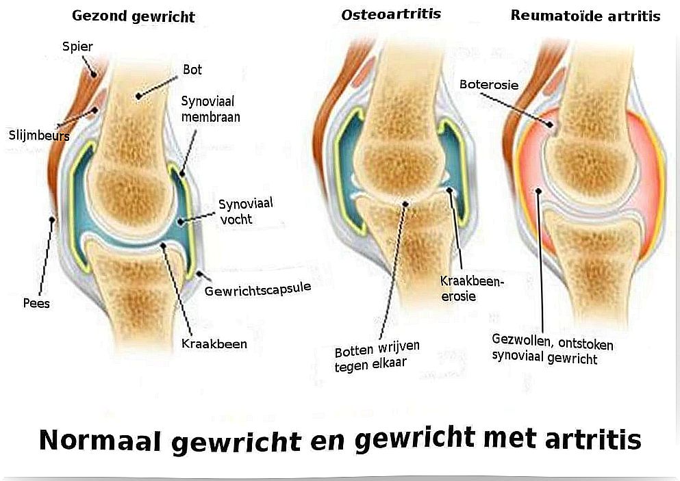 The Differences Between Arthritis, Osteoarthritis, and Osteoporosis