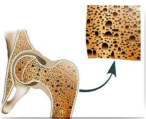 Osteoporosis