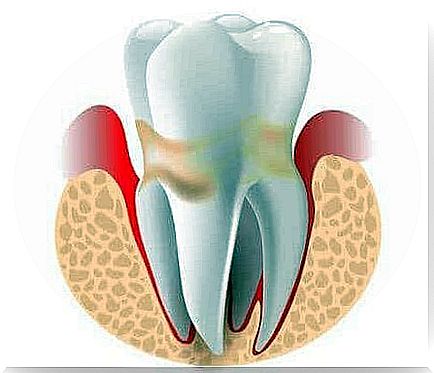 Gingivitis