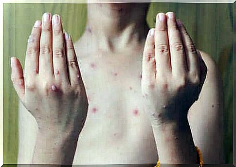 The treatment of herpes zoster in children