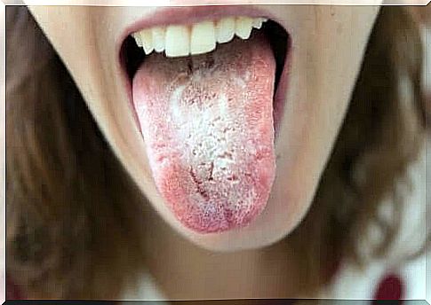 Woman with a white tongue